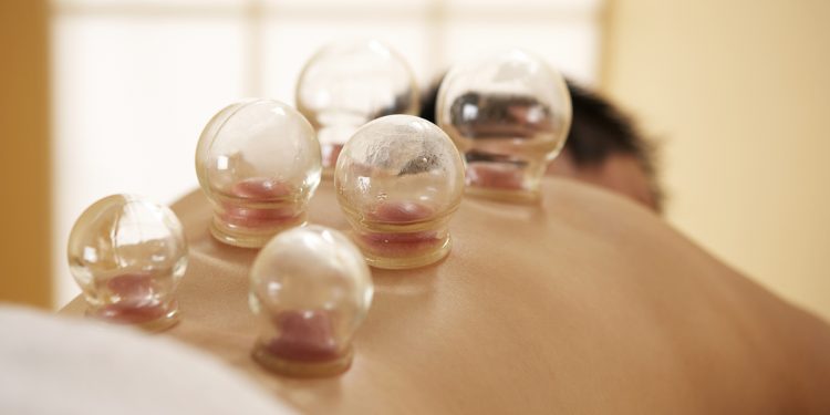 Cupping therapy – an ancient technique to improve blood flow