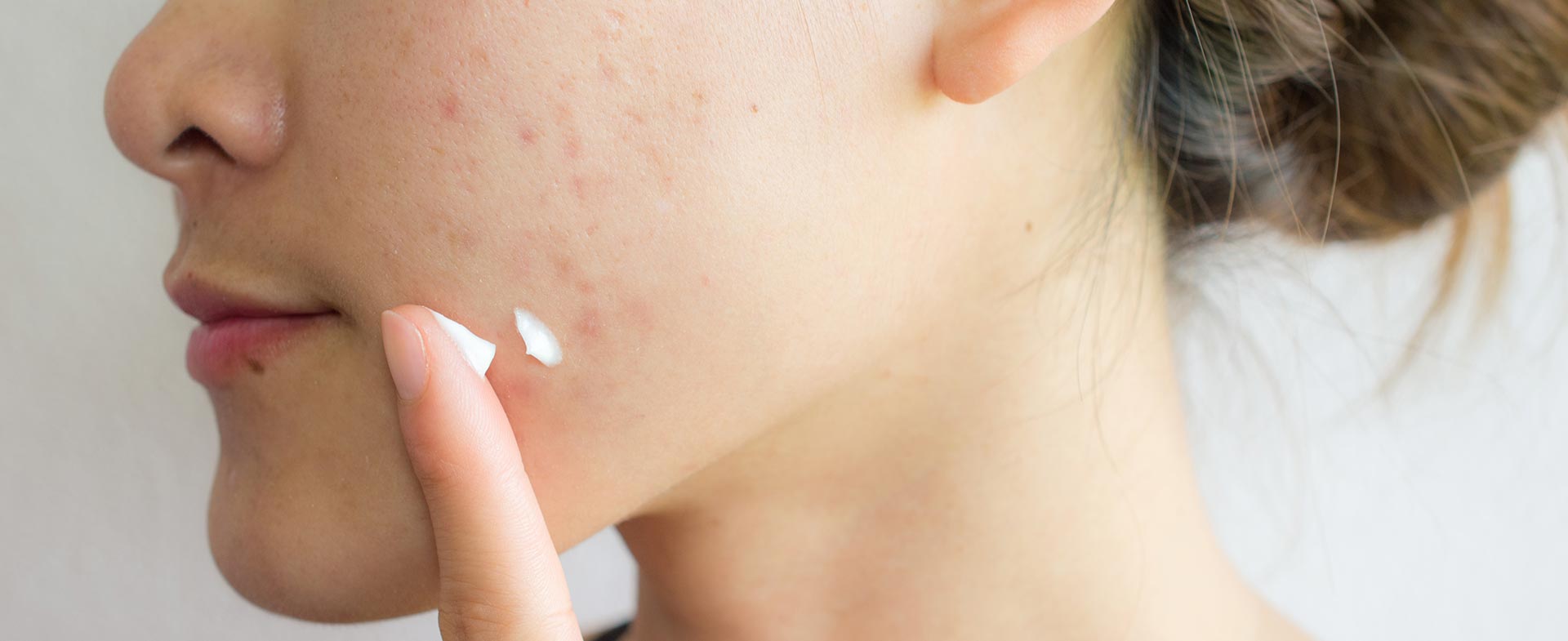 6 Amazing Ways to Treat Acne When You Have Dry Skin